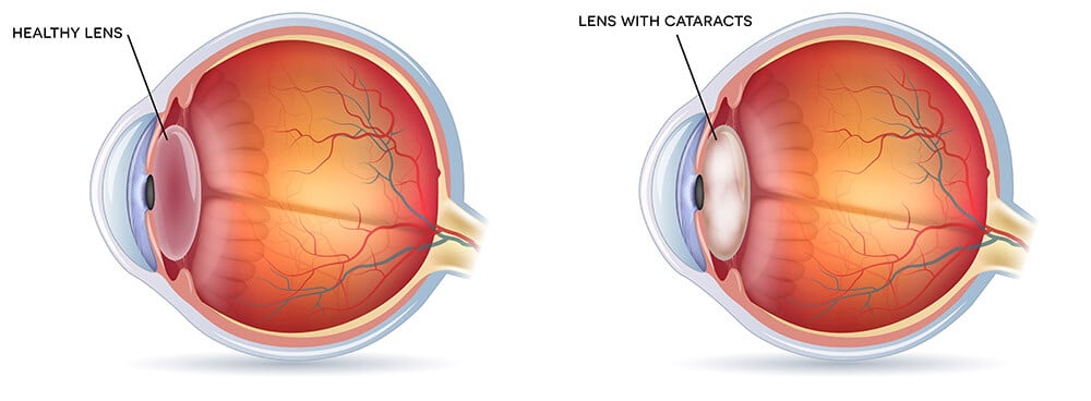 Chart Illustrating a Healthy Lens vs One With a  Cataract