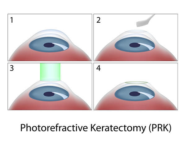 Chart Illustrating the PRK Procedure