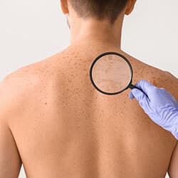 skin cancer check a man's back